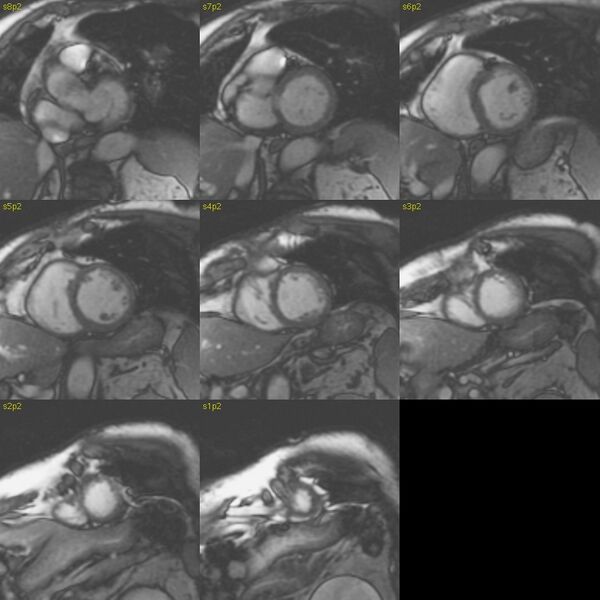 File:Anteroseptal hypokinesia after myocardial infarction (Radiopaedia 15978-15633 E 30).jpg