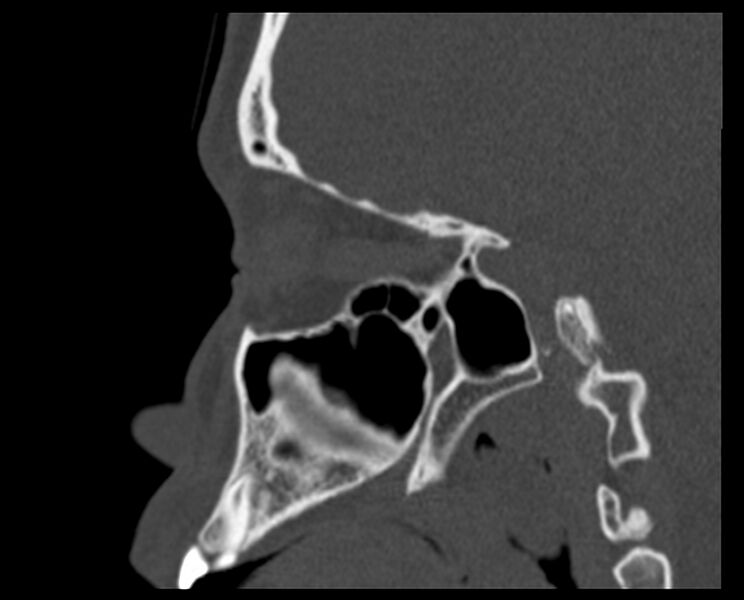 File:Antrochoanal polyp (Radiopaedia 21894-21868 Sagittal bone window 27).jpg
