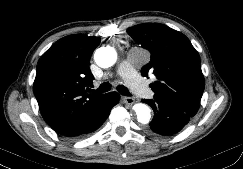 File:Aortic arch saccular aneurysm (Radiopaedia 19430-19457 B 13).jpg