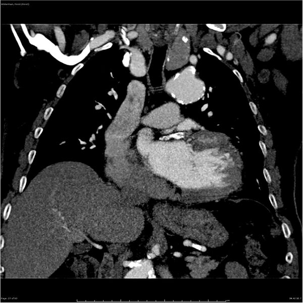 File:Aortic dissection - Stanford type A (Radiopaedia 26183-26315 A 27).jpg