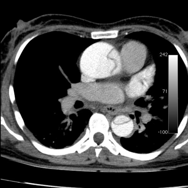 File:Aortic dissection - Stanford type A (Radiopaedia 29247-29659 A 40).jpg