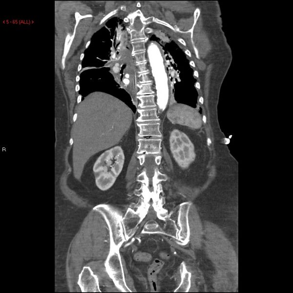 File:Aortic intramural hematoma (Radiopaedia 27746-28001 B 42).jpg