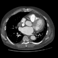 Aorto-coronary bypass graft aneurysms (Radiopaedia 40562-43157 A 70).png