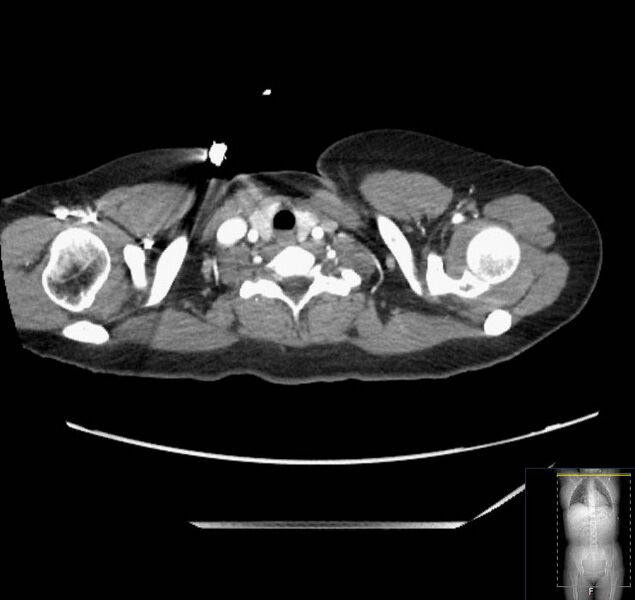 File:Appendicitis (CT angiogram) (Radiopaedia 154713-127660 Axial 245).jpg