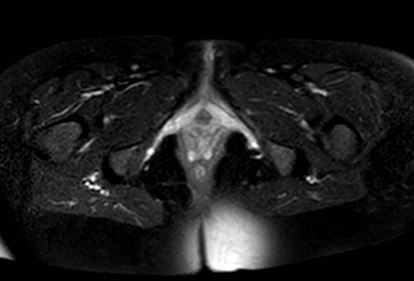 Appendicitis in gravida (MRI) (Radiopaedia 89433-106395 Axial T2 SPAIR 79).jpg