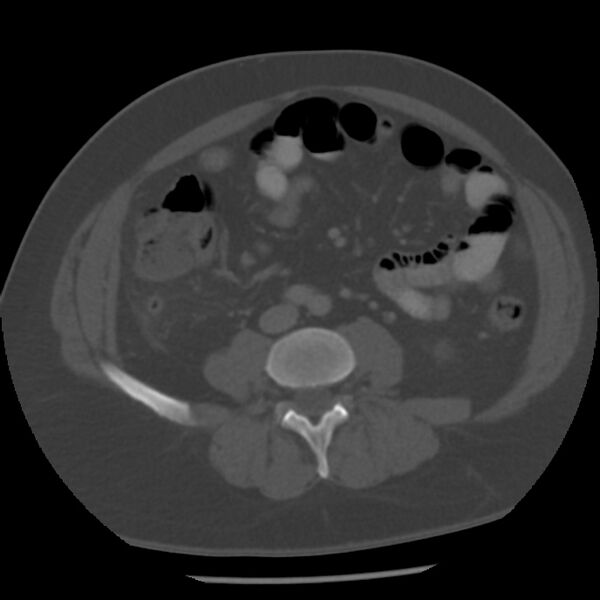File:Appendicitis with perforation (Radiopaedia 35790-37342 Axial bone window 30).jpg