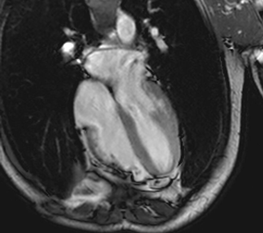 Arrhythmogenic right ventricular cardiomyopathy (Radiopaedia 39806-42237 D 54).jpg
