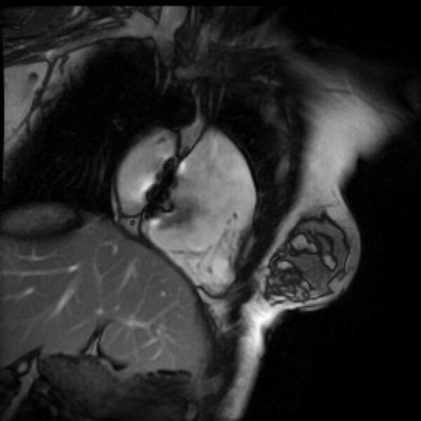 File:Arrhythmogenic right ventricular cardiomyopathy (Radiopaedia 87505-103850 2ch (RV) Cine SSFP 74).jpg