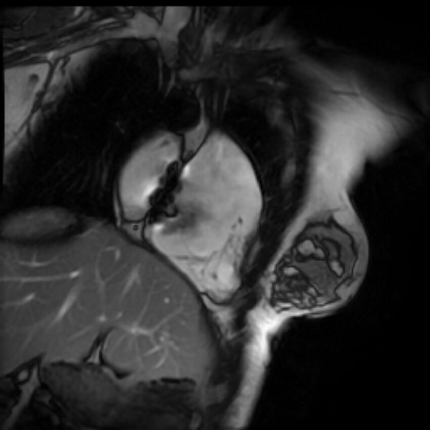 Arrhythmogenic right ventricular cardiomyopathy (Radiopaedia 87505-103850 2ch (RV) Cine SSFP 74).jpg