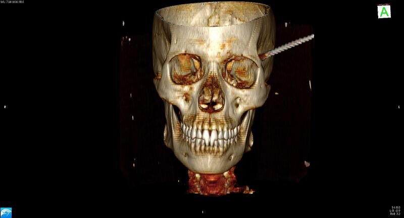 File:Arrow injury to the head (Radiopaedia 75266-86388 3D vertical 3).jpg