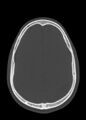 Arrow injury to the head (Radiopaedia 75266-86388 Axial bone window 92).jpg