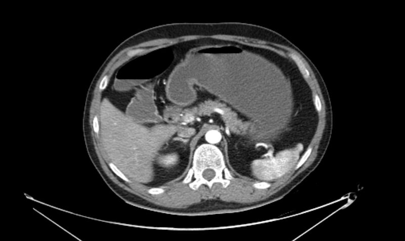 File:Arterial occlusive mesenteric ischemia (Radiopaedia 84641-100060 A 44).jpg