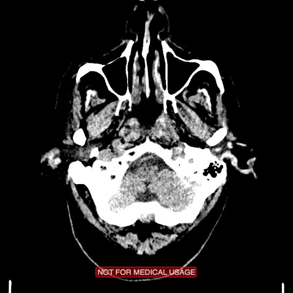 File:Artery of Percheron infarction (Radiopaedia 28679-28967 Axial non-contrast 12).jpg