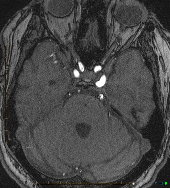 File:Artifactual basilar artery stenosis due to metallic stent (Radiopaedia 31206-31922 Axial MRA 11).jpg