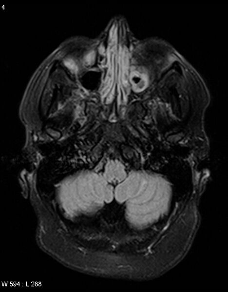 File:Astroblastoma (Radiopaedia 39792-42217 Axial FLAIR 3).jpg