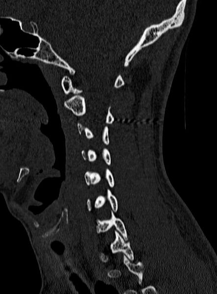 File:Atlantoaxial subluxation (Radiopaedia 44681-48450 Sagittal bone window 37).jpg