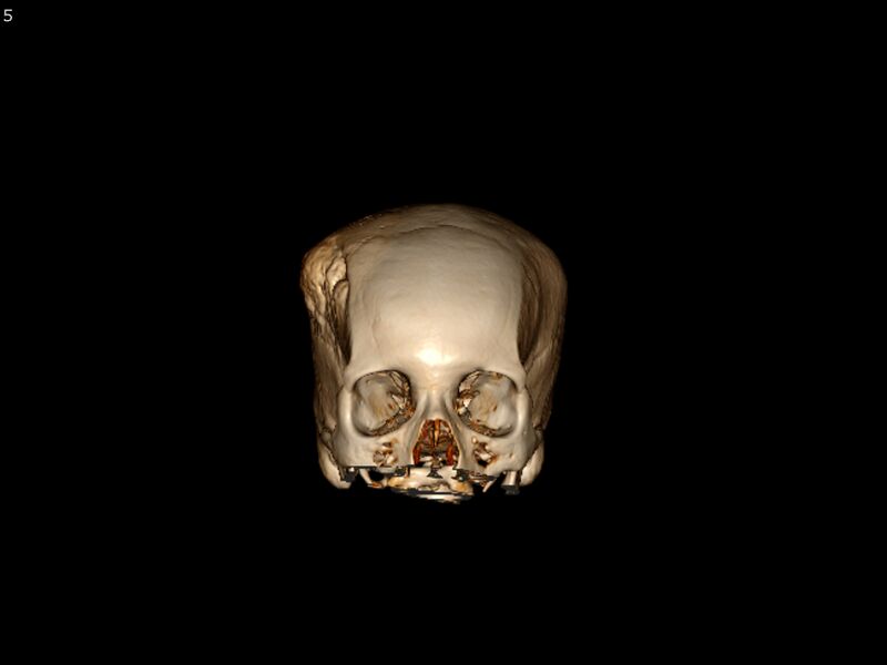 File:Atypical meningioma - intraosseous (Radiopaedia 64915-73867 3D volume render 5).jpg