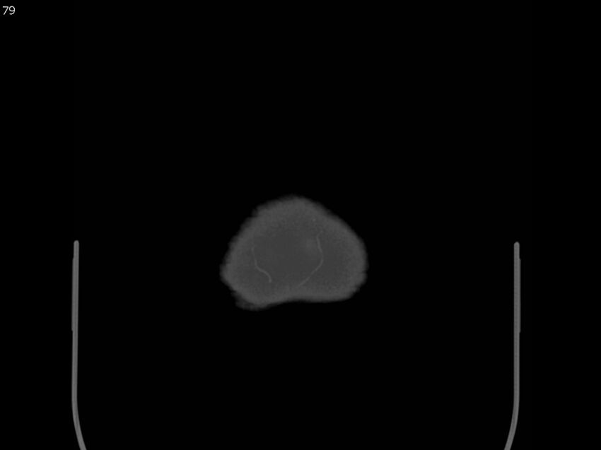 Atypical meningioma - intraosseous (Radiopaedia 64915-73867 Axial C+ bone window 79).jpg