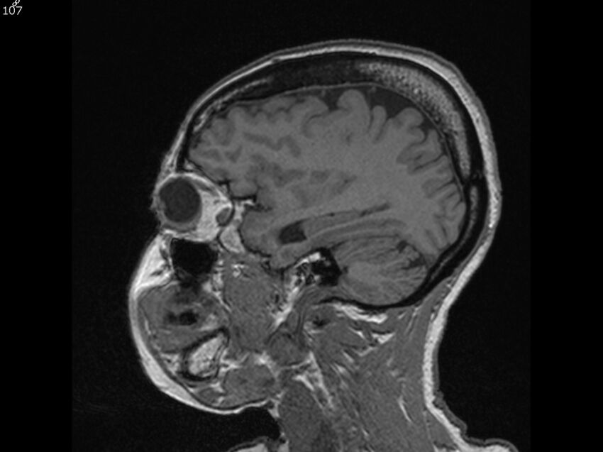 Atypical meningioma - intraosseous (Radiopaedia 64915-74572 Sagittal T1 107).jpg