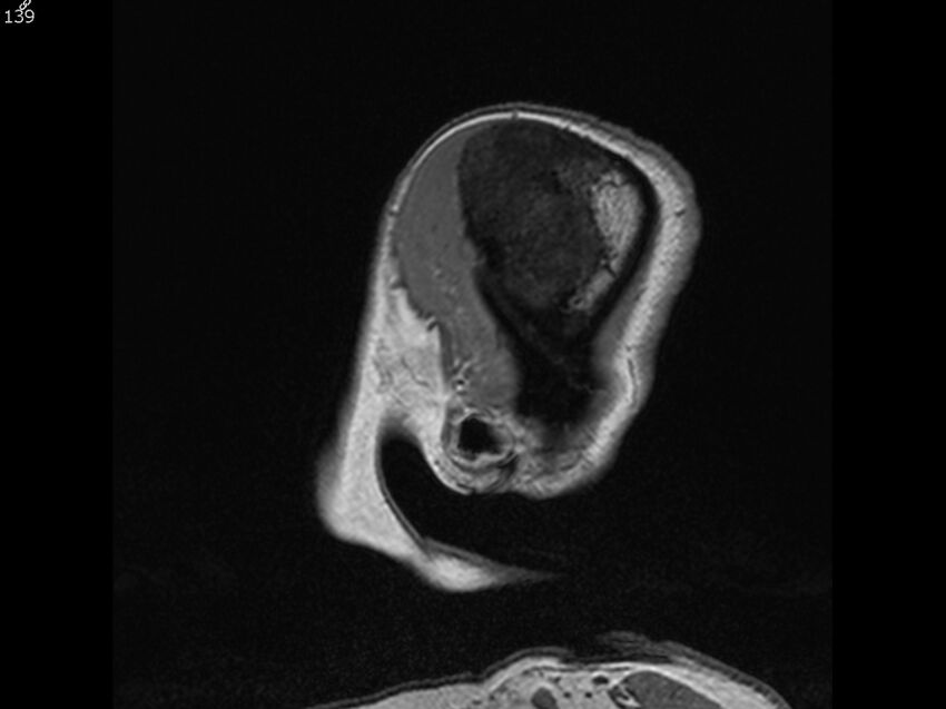 Atypical meningioma - intraosseous (Radiopaedia 64915-74572 Sagittal T1 139).jpg