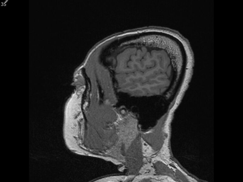 File:Atypical meningioma - intraosseous (Radiopaedia 64915-74572 Sagittal T1 35).jpg