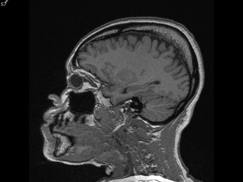 File:Atypical meningioma - intraosseous (Radiopaedia 64915-74572 Sagittal T1 57).jpg