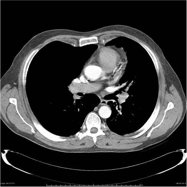 File:Atypical pneumonia - Q fever (Radiopaedia 21993-21989 C+ arterial phase 24).jpg