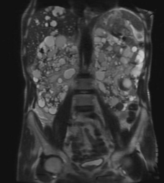 File:Autosomal dominant polycystic kidney disease (Radiopaedia 11220-11585 Coronal 1).jpg