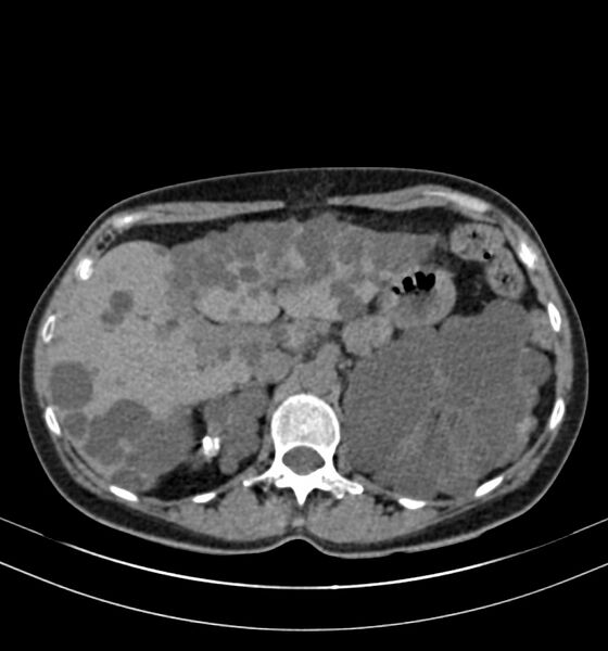 File:Autosomal dominant polycystic kidney disease (Radiopaedia 41918-44922 Axial non-contrast 8).jpg