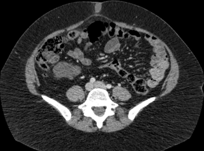 File:Autosomal dominant polycystic kidney disease (Radiopaedia 57124-64017 A 75).jpg