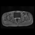 Avascular necrosis of the hip (Radiopaedia 29563-30067 Axial T1 C+ fat sat 7).jpg