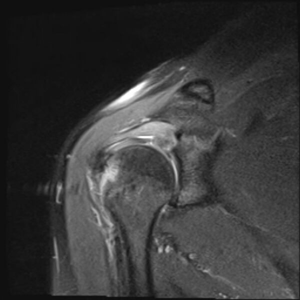 File:Avulsion fracture - greater tuberosity of humerus (Radiopaedia 71216-81515 Coronal PD fat sat 12).jpg
