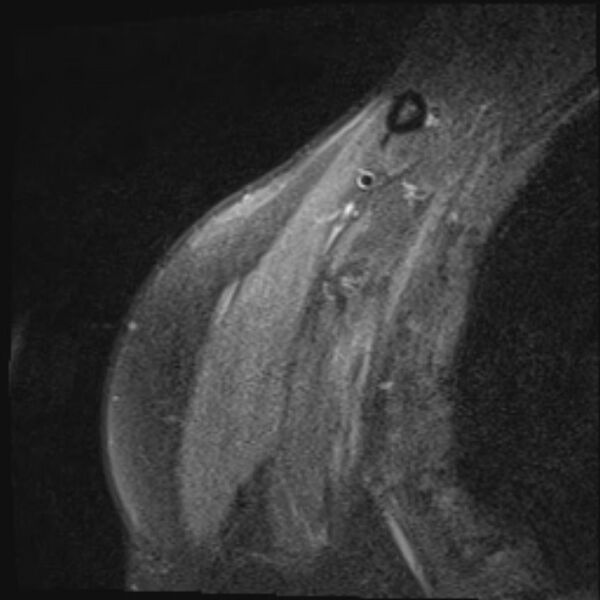 File:Avulsion fracture - greater tuberosity of humerus (Radiopaedia 71216-81515 Coronal PD fat sat 19).jpg