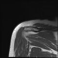 Avulsion fracture - greater tuberosity of humerus (Radiopaedia 71216-81515 Coronal T1 4).jpg