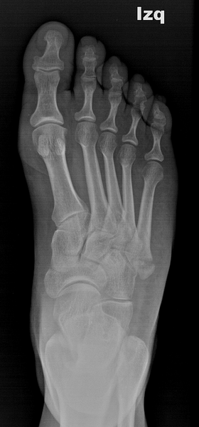 File:Avulsion fracture of the 5th metatarsal styloid (Pseudo-Jones) (Radiopaedia 33982-35199 Frontal 1).png