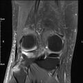 Avulsion fracture of the fibular head (Radiopaedia 74804-85808 Coronal PD fat sat 27).jpg