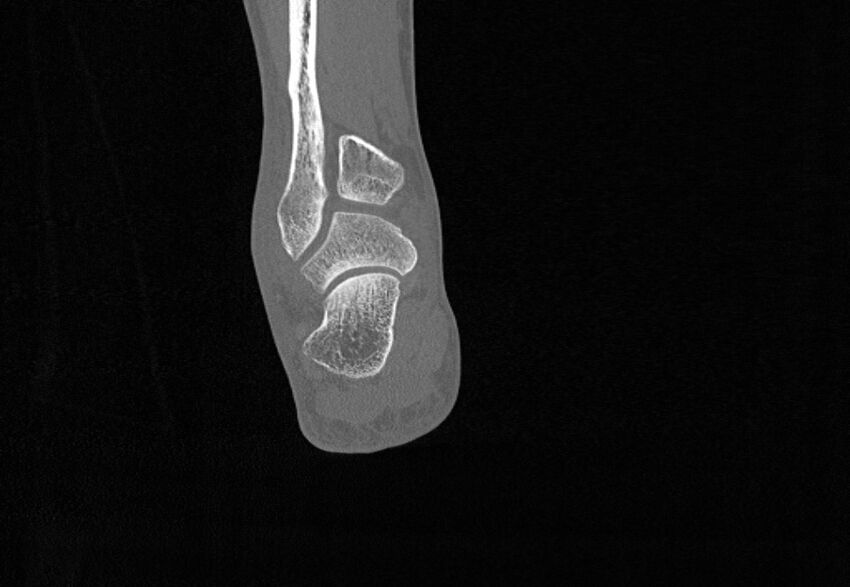 Avulsion fractures of talus and calcaneus (Radiopaedia 48277-53155 Coronal bone window 77).jpg
