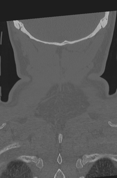 File:Axis peg fracture (type 3) and atlas lateral mass (type 4) fracture (Radiopaedia 37474-39324 Coronal bone window 59).png