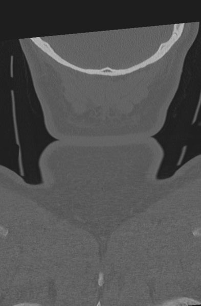 File:Axis peg fracture (type 3) and atlas lateral mass (type 4) fracture (Radiopaedia 37474-39324 Coronal bone window 69).png