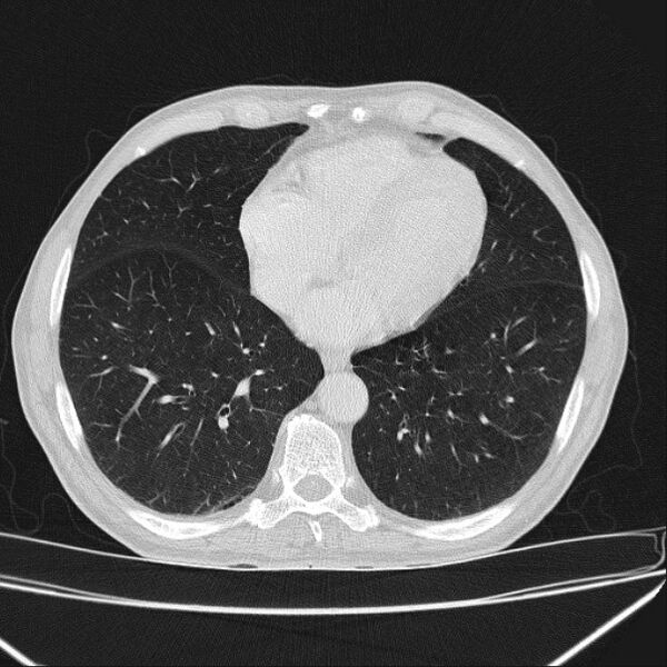 File:Azygos lobe (Radiopaedia 38259-40275 Axial lung window 58).jpg