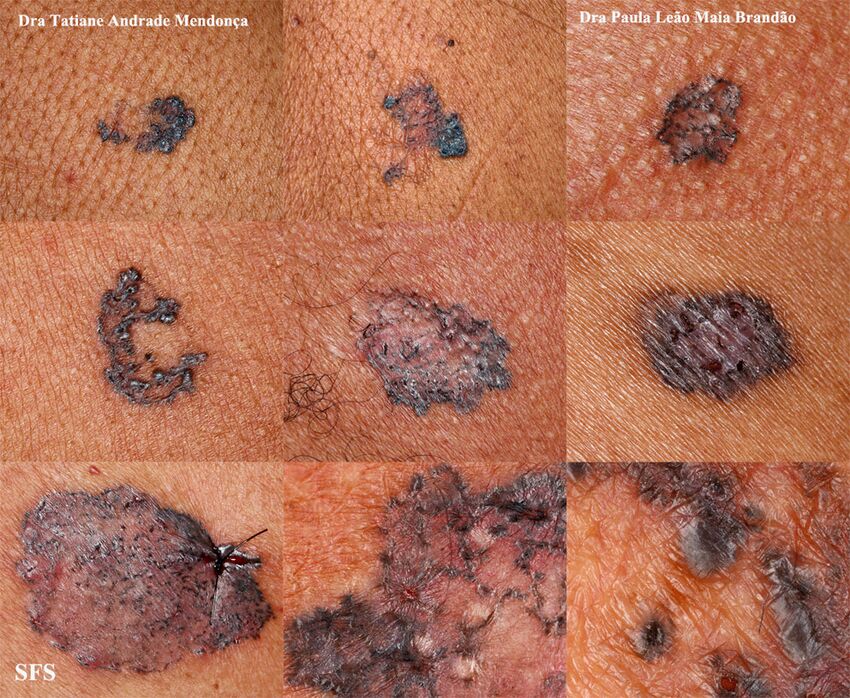 Basal Cell Carcinoma (Dermatology Atlas 219).jpg