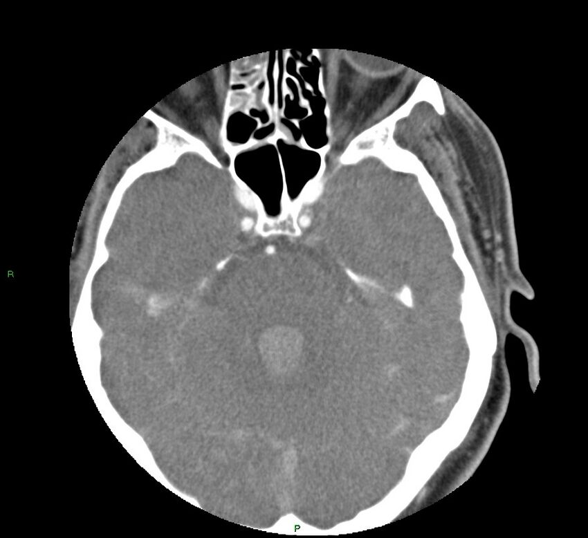 Basal ganglia hemorrhage (Radiopaedia 58763-65985 D 61).jpg
