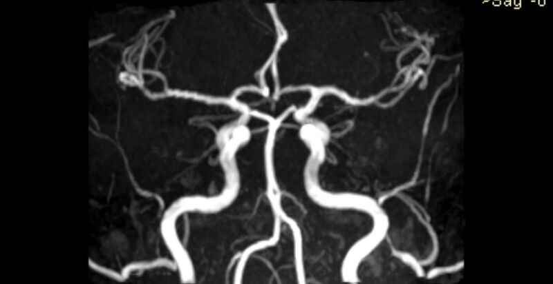 File:Basilar artery fenestration (Radiopaedia 74537-85455 3D TOF MIP MRA 2).jpg