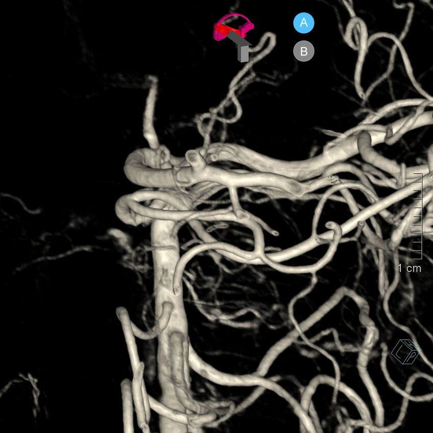 Basilar artery perforator aneurysm (Radiopaedia 82455-97734 3D view left VA 173).jpg