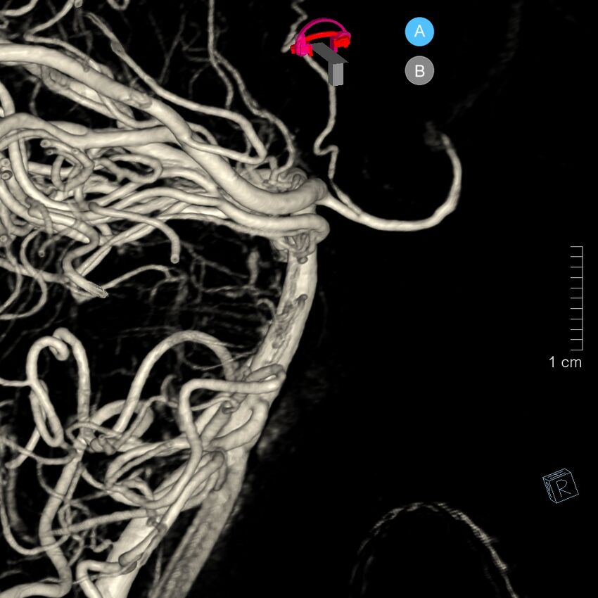 Basilar artery perforator aneurysm (Radiopaedia 82455-97734 3D view left VA 68).jpg