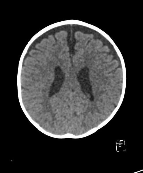 File:Benign enlargement of subarachnoid spaces in infancy (BESS) (Radiopaedia 87459-103795 Axial non-contrast 34).jpg