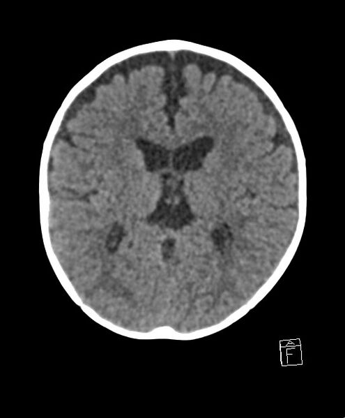 File:Benign enlargement of subarachnoid spaces in infancy (BESS) (Radiopaedia 87459-103795 Axial non-contrast 41).jpg