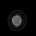 Benign leiomyoma with hydropic features (Radiopaedia 89250-106130 B 6).jpg