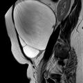 Benign seromucinous cystadenoma of the ovary (Radiopaedia 71065-81300 Sagittal T2 18).jpg