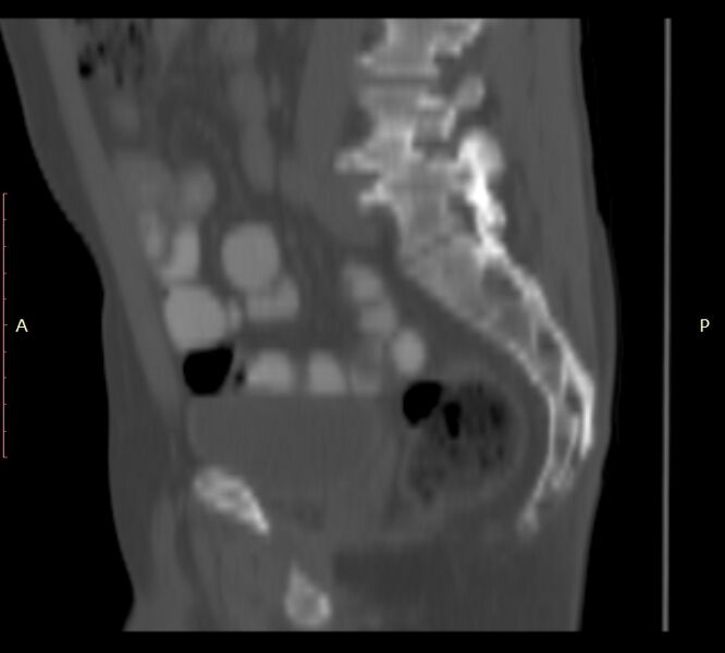 File:Bertolotti syndrome (Radiopaedia 58974-66235 Sagittal bone window 16).jpg